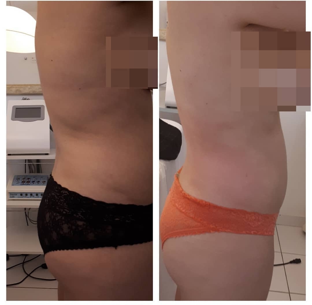 Tratamentos exclusivos para cada cliente resultado apos 5 Sessões. estética esteticista massoterapeuta designer de sobrancelhas depilador(a)