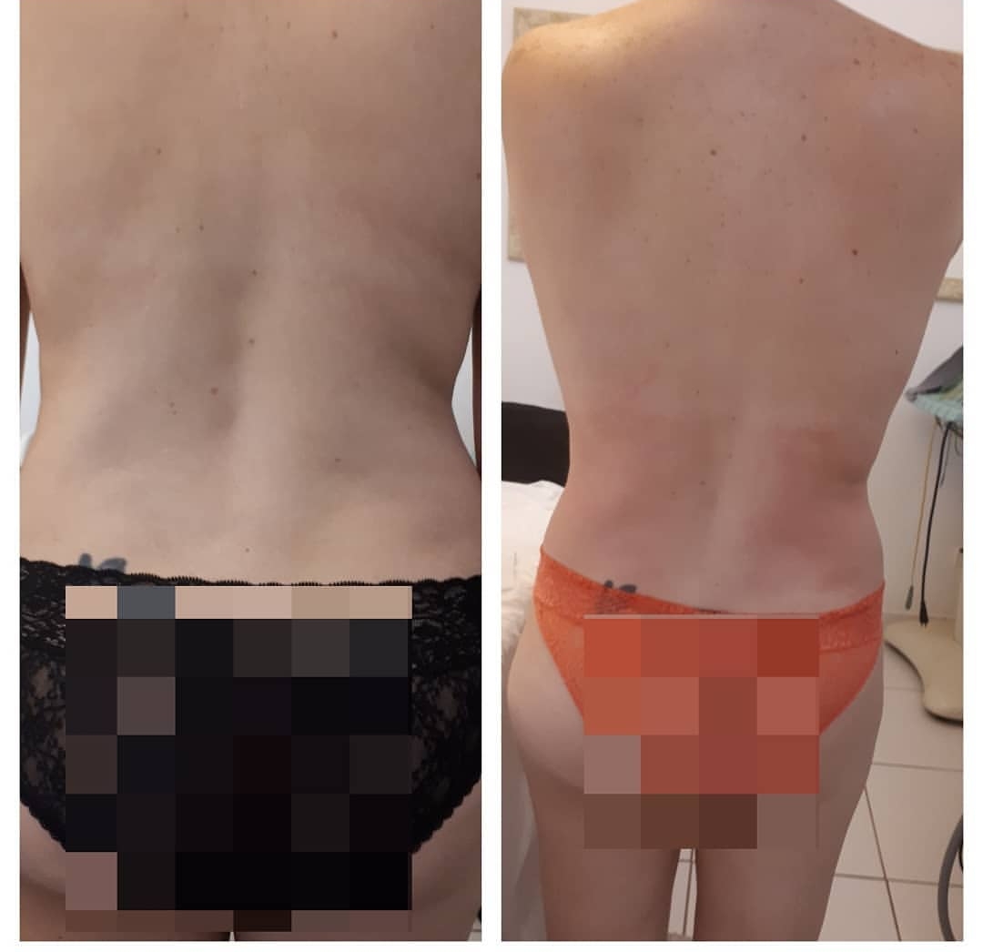 Tratamentos exclusivos para cada cliente resultado apos 5 sessão. estética esteticista massoterapeuta designer de sobrancelhas depilador(a)
