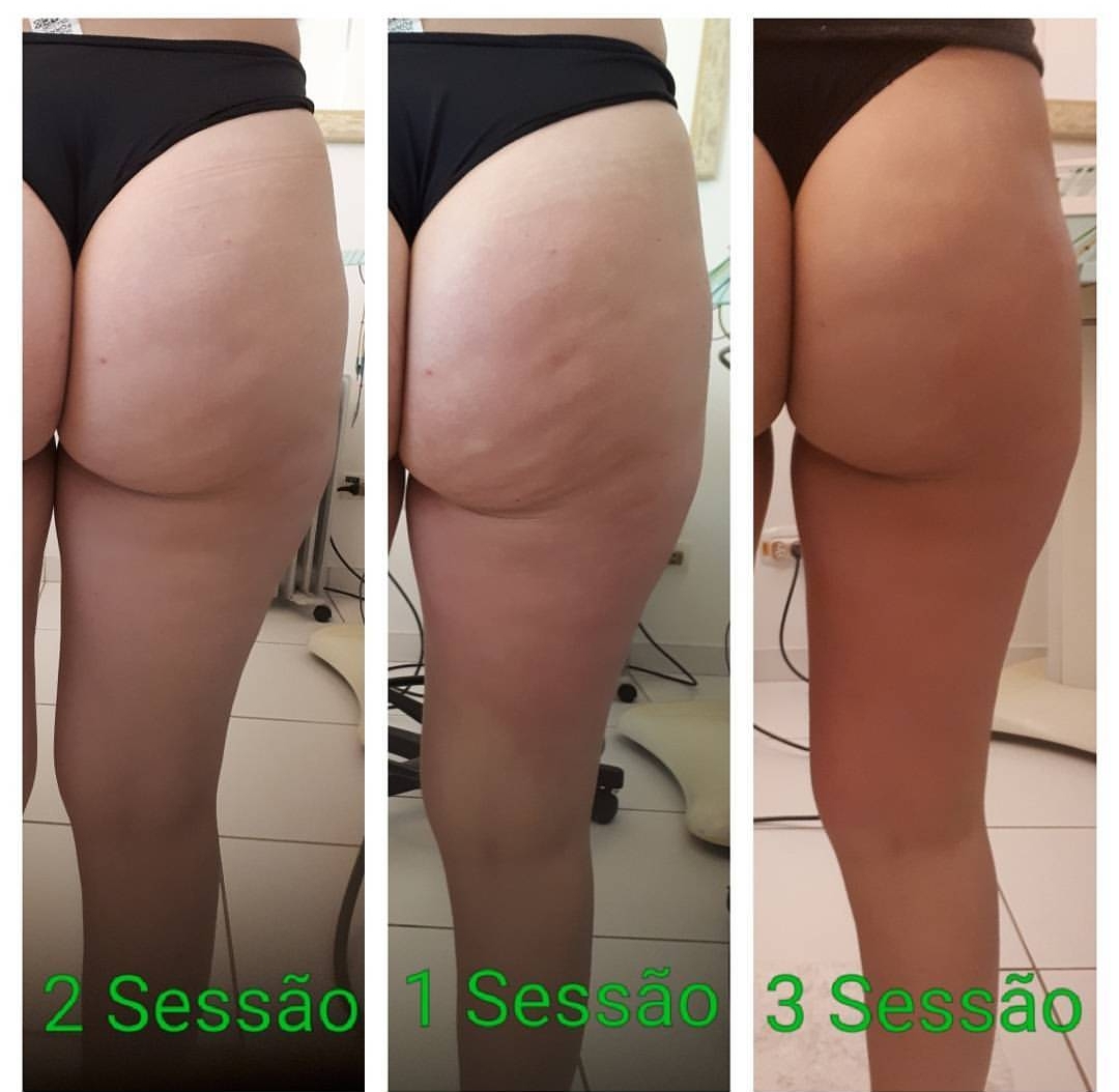 Tratamento cellu off. estética esteticista massoterapeuta designer de sobrancelhas depilador(a)