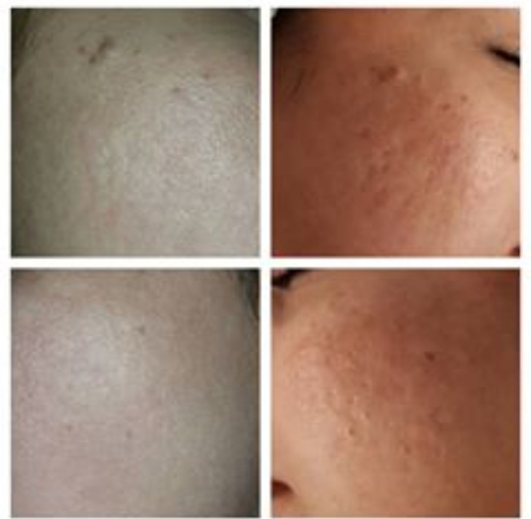 Tratamentos para cicatriz de acne. estética esteticista massoterapeuta designer de sobrancelhas depilador(a)