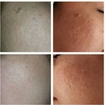 Tratamentos para cicatriz de acne.