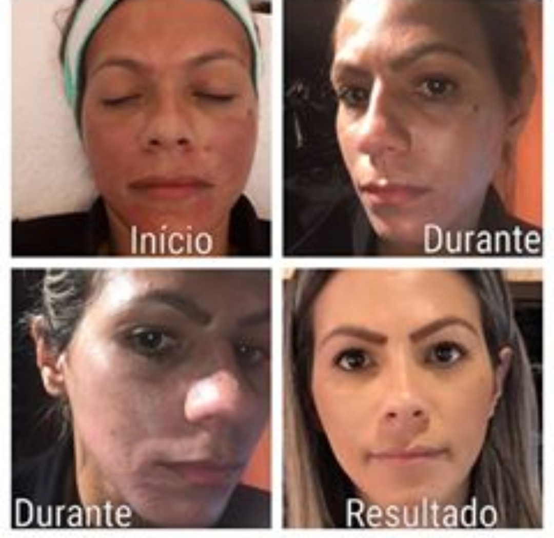 Clareamento de melasma. estética esteticista massoterapeuta designer de sobrancelhas depilador(a)
