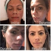 Clareamento de melasma.