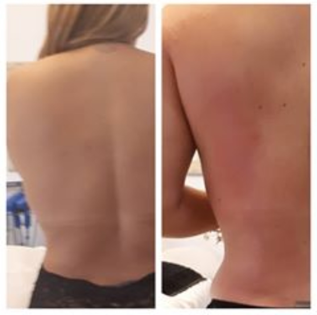 Tratamentos de redução de medidas. estética esteticista massoterapeuta designer de sobrancelhas depilador(a)