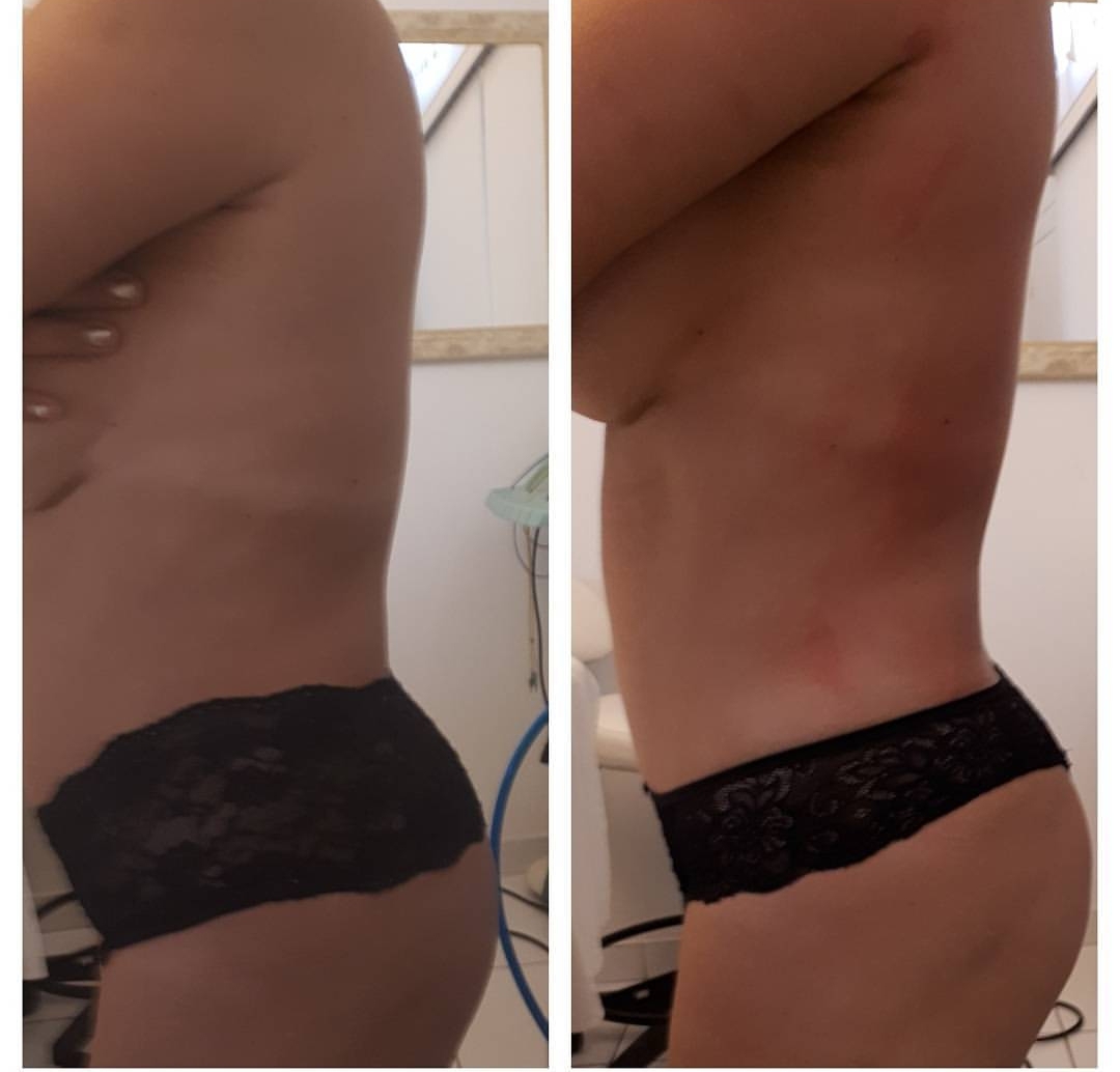 Tratamentos de redução de medidas  estética esteticista massoterapeuta designer de sobrancelhas depilador(a)