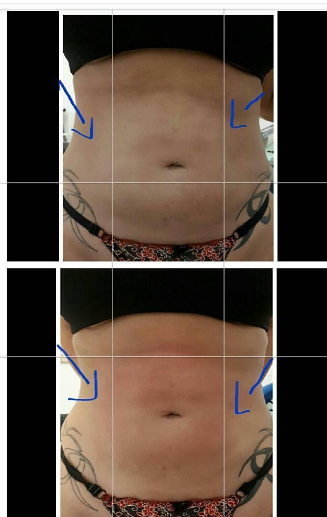 Tratamento com radio frequência com apenas uma sessão  estética esteticista massoterapeuta designer de sobrancelhas depilador(a)