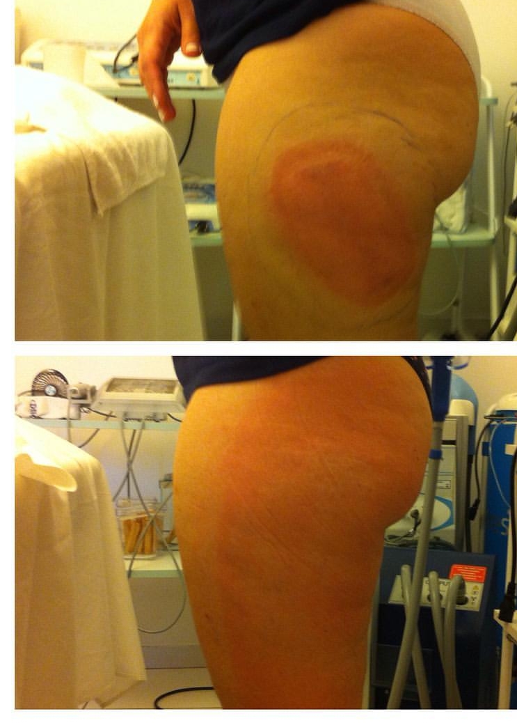 Sessão de criolipolise para culotes  estética esteticista massoterapeuta designer de sobrancelhas depilador(a)