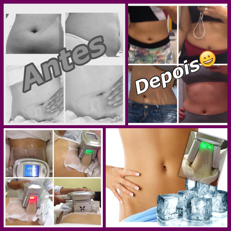 Criolipólise - Antes e depois 
Congelamento de gordura localizada. estética esteticista