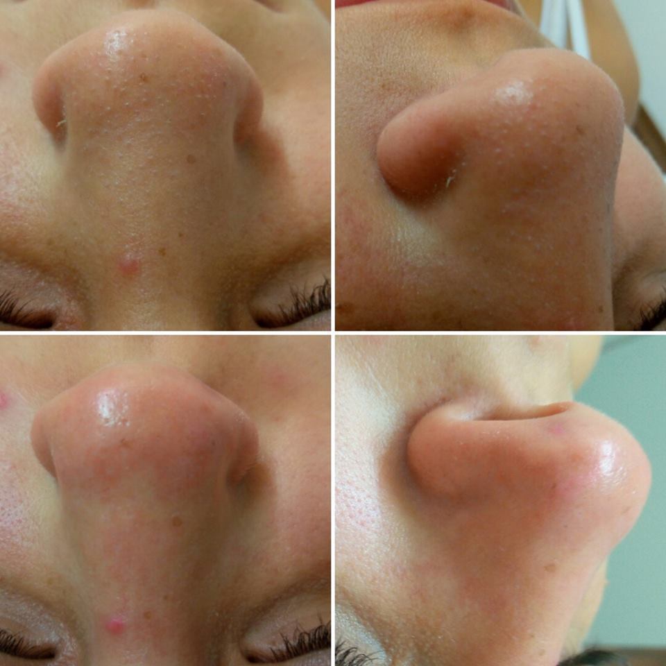 Antes e depois limpeza de pele profunda. estética esteticista