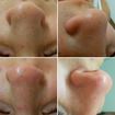 Antes e depois limpeza de pele profunda.