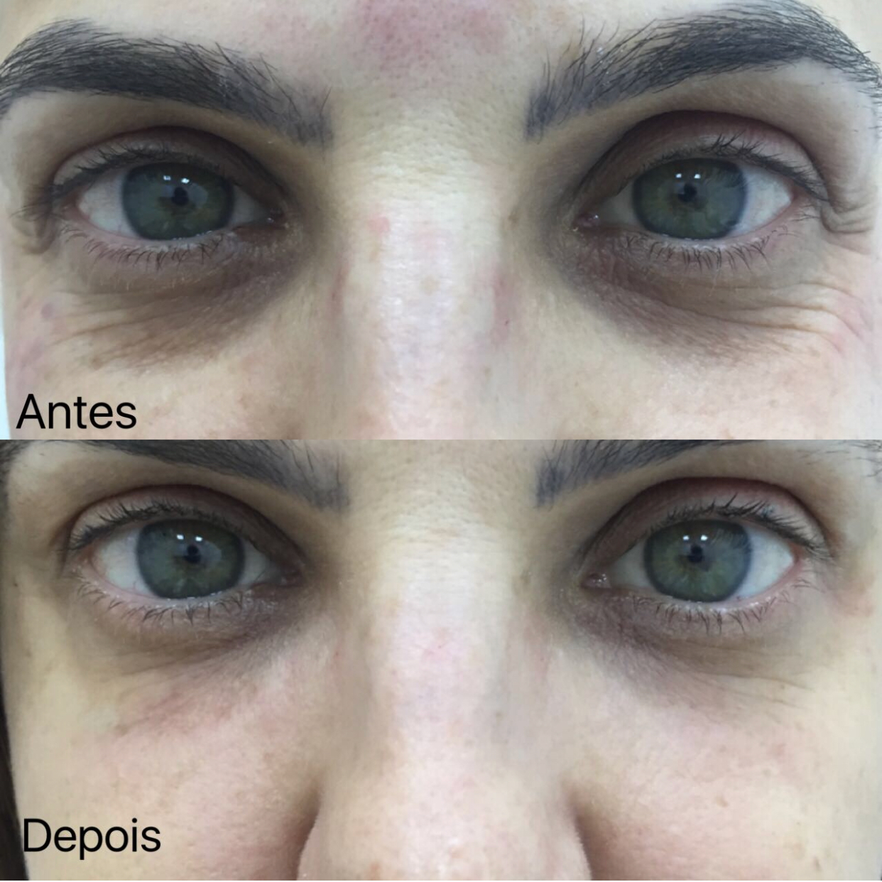 botox olheiras antes e depois
