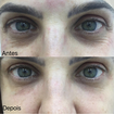 Ante e depois de preenchimento de olheira e meso botox . #preenchimentodeolheira #mesobotox #botox #acidohialuronico