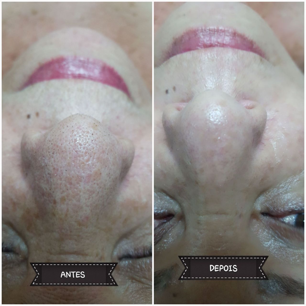Limpeza de pele profunda em pele madura. estética esteticista