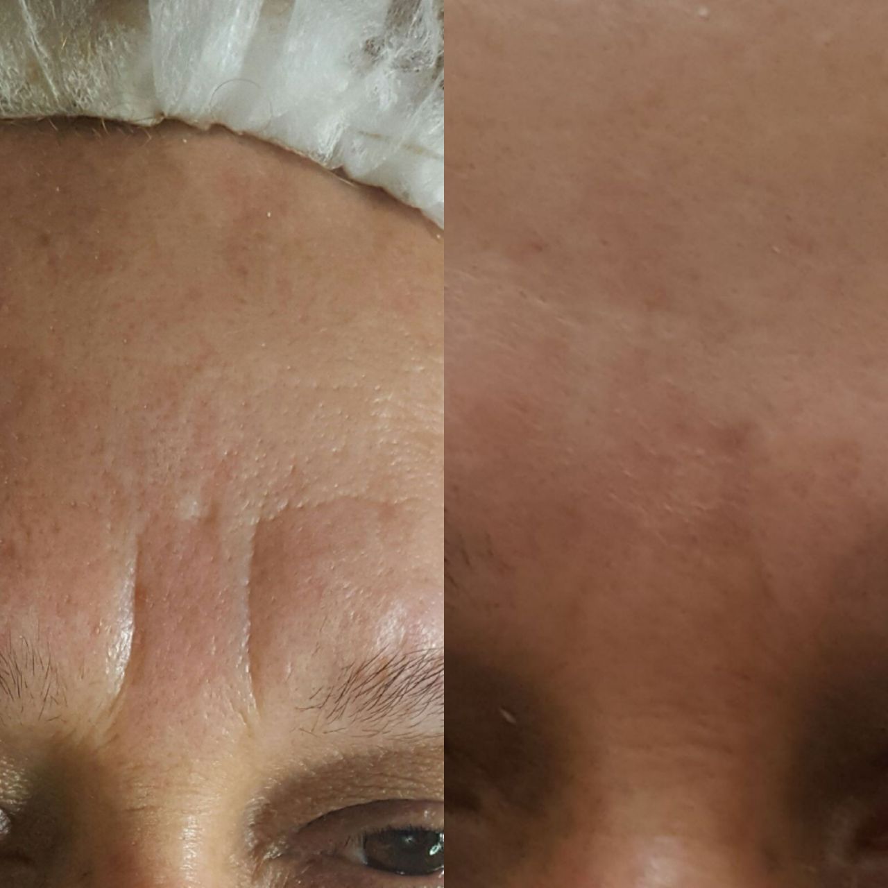 Eletrolifting ( tratamento para linhas de expressões  no corrugador) estética esteticista