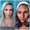 Camuflagem com produtos Kryolan em pele com imperfeição severa de melasma.