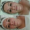 Antes e depois da técnica kobido e hidratação facial