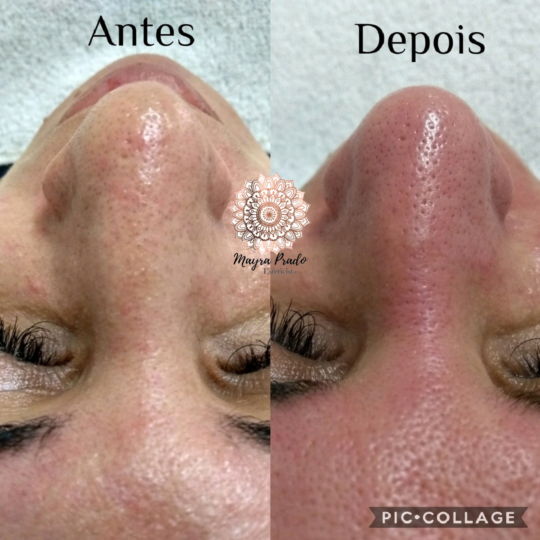 Limpeza de Pele com Extração Manual.   estética esteticista
