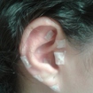 Auriculoterapia 