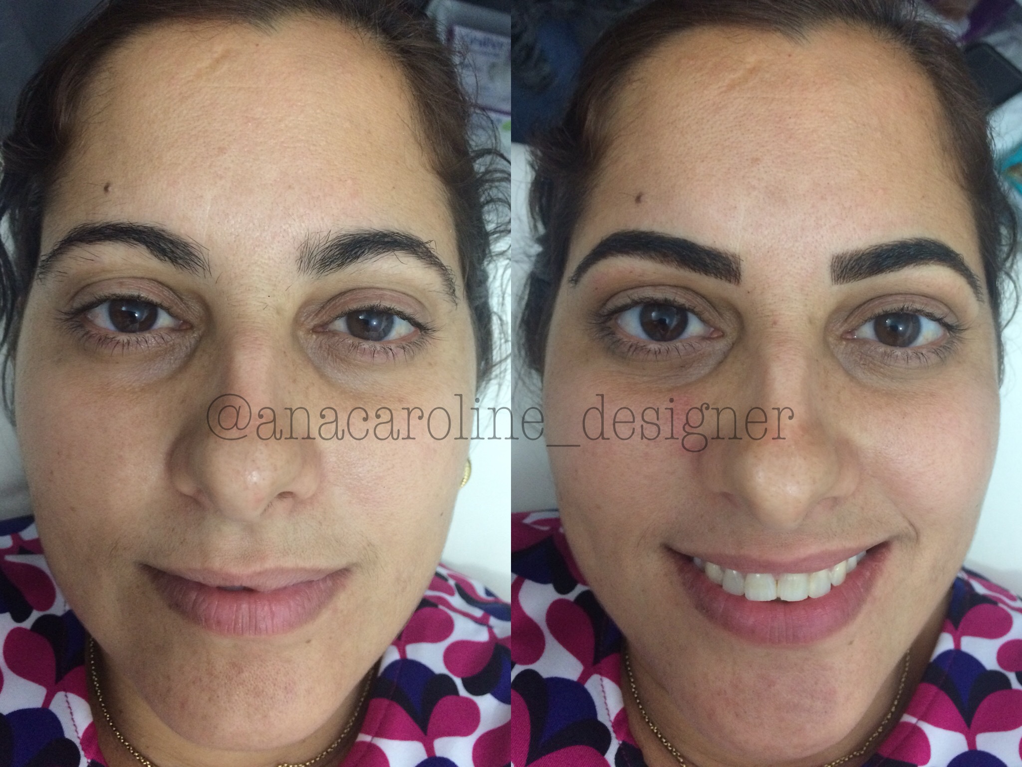 Micropigmentação fio a fio feita com o indutor manual chamado tebori. 
Design e correção feita levando em consideração o desejo da cliente, e os limites de seu rosto. A cliente ficou apaixonada pelo resultado! 
#micropigmentacao #microblading #designeranacaroline #pmu #autoestima #sobrancelhasnovas #sobrancelhas #eyebrows #designdesobrancelhas  estética designer de sobrancelhas micropigmentador(a) maquiador(a)