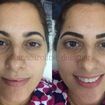 Micropigmentação fio a fio feita com o indutor manual chamado tebori. 
Design e correção feita levando em consideração o desejo da cliente, e os limites de seu rosto. A cliente ficou apaixonada pelo resultado! 
#micropigmentacao #microblading #designeranacaroline #pmu #autoestima #sobrancelhasnovas #sobrancelhas #eyebrows #designdesobrancelhas 
