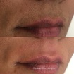 Depilação Facial - Buço