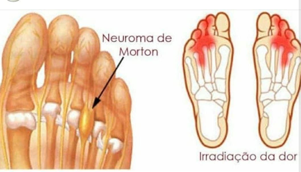 Neuroma de Morton é o nome que se dá a uma lesão que ocorre em um nervo do pé, mais especificamente no nervo que passa entre o terceiro e o quarto dedo.
Causas
As causas exatas do neuroma de Morton ainda são desconhecidas. Os médicos, no entanto, acreditam que este problema possa estar relacionado a uma reação do nervo do pé a qualquer tipo de irritação, pressão ou lesão que ocorra.
O uso de sapatos com salto alto ou sapatos que são muito apertados ou mal encaixados colocam pressão extra sobre os dedos do pé, aumentando as chances de neuroma de Morton.
Atividades esportivas de alto impacto, como corrida, e esportes que exijam o uso de sapatos mais apertados, como esqui ou escalada, podem aumentar os riscos de uma pessoa vir a ter algum tipo de problema no pé.
As pessoas que têm joanetes, pé chato, arcos altos do pé e outras deformidades estão em maior risco de desenvolver neuroma de Morton também.
Ao contrário do que algumas pessoas podem achar, não há nenhum sinal exterior de que uma pessoa está com neuroma de Morton. É comum ligar esta condição à formação de um caroço, mas o que acontece não é exatamente isso. Em vez de surgir um calombo no pé, uma pessoa com neuroma de Morton sente como se estivesse com uma pedra no sapato, embora isso não seja visível. Pode haver também queimação, formigamento e dormência na região afetada pela lesão.

Especialistas que podem diagnosticar Neuroma de Morton são:
Clínico geral
Podólogo
Ortopedista
Neurologista
Reumatologista
Infectologista

Diagnóstico de Neuroma de Morton
Raio-X
Ultrassonografia
Exame de ressonância podólogo(a)