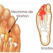 Neuroma de Morton é o nome que se dá a uma lesão que ocorre em um nervo do pé, mais especificamente no nervo que passa entre o terceiro e o quarto dedo.
Causas
As causas exatas do neuroma de Morton ainda são desconhecidas. Os médicos, no entanto, acreditam que este problema possa estar relacionado a uma reação do nervo do pé a qualquer tipo de irritação, pressão ou lesão que ocorra.
O uso de sapatos com salto alto ou sapatos que são muito apertados ou mal encaixados colocam pressão extra sobre os dedos do pé, aumentando as chances de neuroma de Morton.
Atividades esportivas de alto impacto, como corrida, e esportes que exijam o uso de sapatos mais apertados, como esqui ou escalada, podem aumentar os riscos de uma pessoa vir a ter algum tipo de problema no pé.
As pessoas que têm joanetes, pé chato, arcos altos do pé e outras deformidades estão em maior risco de desenvolver neuroma de Morton também.
Ao contrário do que algumas pessoas podem achar, não há nenhum sinal exterior de que uma pessoa está com neuroma de Morton. É comum ligar esta condição à formação de um caroço, mas o que acontece não é exatamente isso. Em vez de surgir um calombo no pé, uma pessoa com neuroma de Morton sente como se estivesse com uma pedra no sapato, embora isso não seja visível. Pode haver também queimação, formigamento e dormência na região afetada pela lesão.

Especialistas que podem diagnosticar Neuroma de Morton são:
Clínico geral
Podólogo
Ortopedista
Neurologista
Reumatologista
Infectologista

Diagnóstico de Neuroma de Morton
Raio-X
Ultrassonografia
Exame de ressonância