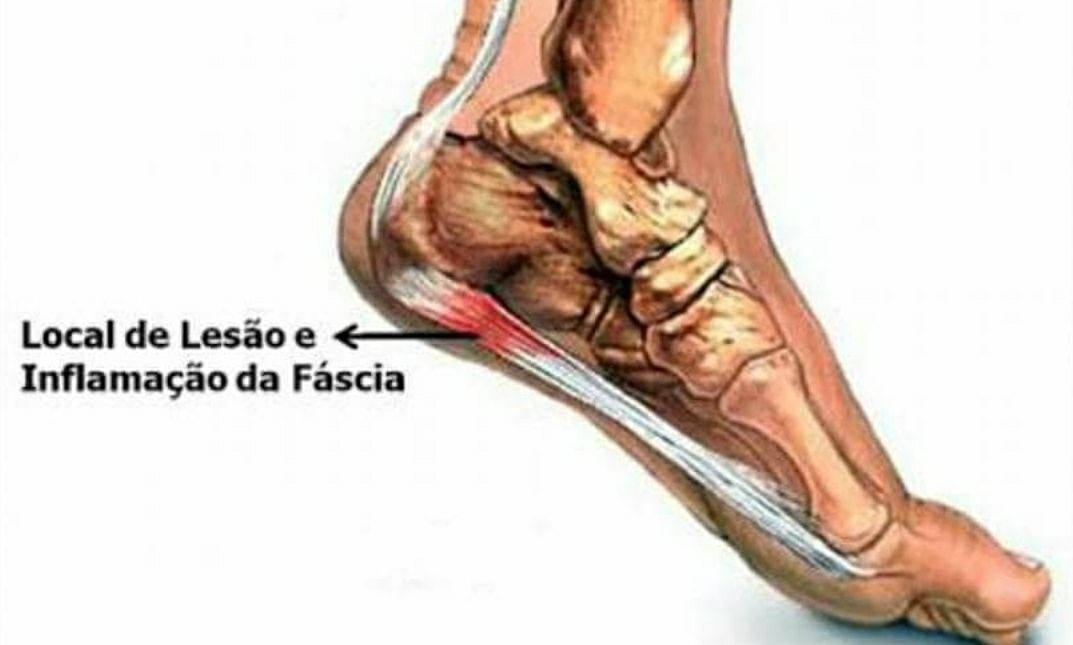 Fascite plantar é um processo inflamatório ou degenerativo que afeta a fáscia plantar (chamada também de aponeurose plantar), uma membrana de tecido conjuntivo fibroso e pouco elástico, que recobre a musculatura da sola do pé, desde o osso calcâneo, que garante o formato do calcanhar, até a base dos dedos dos pés. A doença se manifesta principalmente  entre os 40 e 60 anos. Pode afetar homens e mulheres. Pessoas com sobrepeso, atletas, especialmente os corredores, bailarinos, ginastas, e mulheres por causa do uso frequente de sapatos com saltos muito altos estão mais sujeitas a desenvolver essa condição.
O sintoma característico da fascite plantar é uma dor forte, em facada, debaixo do pé, perto do calcanhar. Em geral, essa dor é mais intensa pela manhã, mas alivia durante o dia, com a deambulação (caminhada). Nada impede, porém, que ela surja em qualquer ponto da fáscia, depois de longos períodos em pé, ou depois de subir escadas ou repousado um pouco.
Inchaço (edema) e vermelhidão (eritema) são outros sinais de inflamação que podem estar presentes nos quadros de fascite plantar. Portadores dessa condição  podem apresentar também  dificuldade para realizar o movimento de dorsiflexão do pé, isto é, apresentam dificuldade para  trazer a ponta do pé na direção da canela.
Sem tratamento, a dor da fascite plantar pode tornar-se crônica e provocar alterações na marcha que revertem em lesões no joelho, quadris e coluna. podólogo(a)