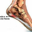Fascite plantar é um processo inflamatório ou degenerativo que afeta a fáscia plantar (chamada também de aponeurose plantar), uma membrana de tecido conjuntivo fibroso e pouco elástico, que recobre a musculatura da sola do pé, desde o osso calcâneo, que garante o formato do calcanhar, até a base dos dedos dos pés. A doença se manifesta principalmente  entre os 40 e 60 anos. Pode afetar homens e mulheres. Pessoas com sobrepeso, atletas, especialmente os corredores, bailarinos, ginastas, e mulheres por causa do uso frequente de sapatos com saltos muito altos estão mais sujeitas a desenvolver essa condição.
O sintoma característico da fascite plantar é uma dor forte, em facada, debaixo do pé, perto do calcanhar. Em geral, essa dor é mais intensa pela manhã, mas alivia durante o dia, com a deambulação (caminhada). Nada impede, porém, que ela surja em qualquer ponto da fáscia, depois de longos períodos em pé, ou depois de subir escadas ou repousado um pouco.
Inchaço (edema) e vermelhidão (eritema) são outros sinais de inflamação que podem estar presentes nos quadros de fascite plantar. Portadores dessa condição  podem apresentar também  dificuldade para realizar o movimento de dorsiflexão do pé, isto é, apresentam dificuldade para  trazer a ponta do pé na direção da canela.
Sem tratamento, a dor da fascite plantar pode tornar-se crônica e provocar alterações na marcha que revertem em lesões no joelho, quadris e coluna.