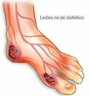 PÉS DIABÉTICOS..TODO CUIDADO É POUCO!!!
O paciente diabético precisa de cuidados e orientações de uma equipe multiprofissional como: endocrinologista, angiologista, nutricionista, dermatologista, fisioterapeuta e podólogo, para uma melhor qualidade de vida.

Alguns dos sinais e sintomas:

Pé frio ou muito quente
Dor em repouso
Sensação de pé dormente
Pele ressecada
Dermatite ocre
Ferida com demora de cicatrização podólogo(a)