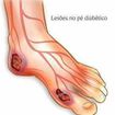 PÉS DIABÉTICOS..TODO CUIDADO É POUCO!!!
O paciente diabético precisa de cuidados e orientações de uma equipe multiprofissional como: endocrinologista, angiologista, nutricionista, dermatologista, fisioterapeuta e podólogo, para uma melhor qualidade de vida.

Alguns dos sinais e sintomas:

Pé frio ou muito quente
Dor em repouso
Sensação de pé dormente
Pele ressecada
Dermatite ocre
Ferida com demora de cicatrização
