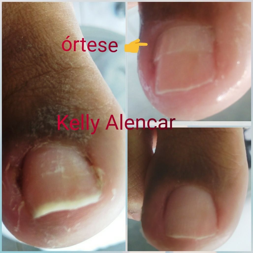Existem diversas técnicas de onicoórteses de tratamento tem o objetivo de corrigir o formato de unhas com curvatura muito elevada, o que gera desconfortos e agressões na pele em sua volta.
As órteses – aparelhinhos metálicos , acrílicos ou de fibra de memória molecular tem sido indicadas para casos de unhas deformadas, encravadas ou com tendência a encravar.
As órteses atuam como alavanca que força a lamina no seu sentido contrário, corrigindo sua curvatura.
O processo é indolor, pois os aparelhos são aplicados sobre a lâmina da unha.
O período do tratamento depende muito da curvatura de cada lamina, em média é de 5 a 9 meses devendo ocorrer uma manutenção a cada 20 dias. podólogo(a)