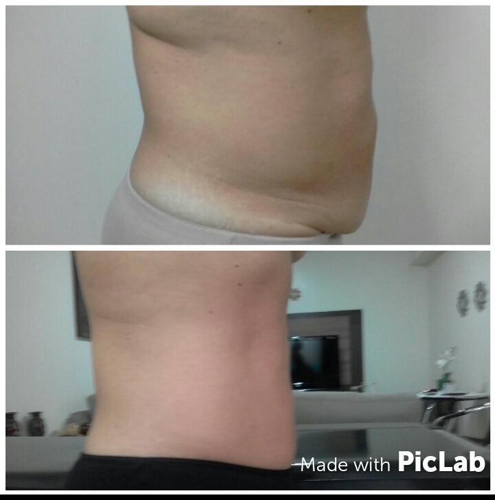 10 sessões de modeladora com ultrassom e argiloterapia para perda de gordura abdominal, cliente perdeu 14cm de gordura abdominal.  estética esteticista depilador(a)