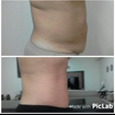 10 sessões de modeladora com ultrassom e argiloterapia para perda de gordura abdominal, cliente perdeu 14cm de gordura abdominal. 