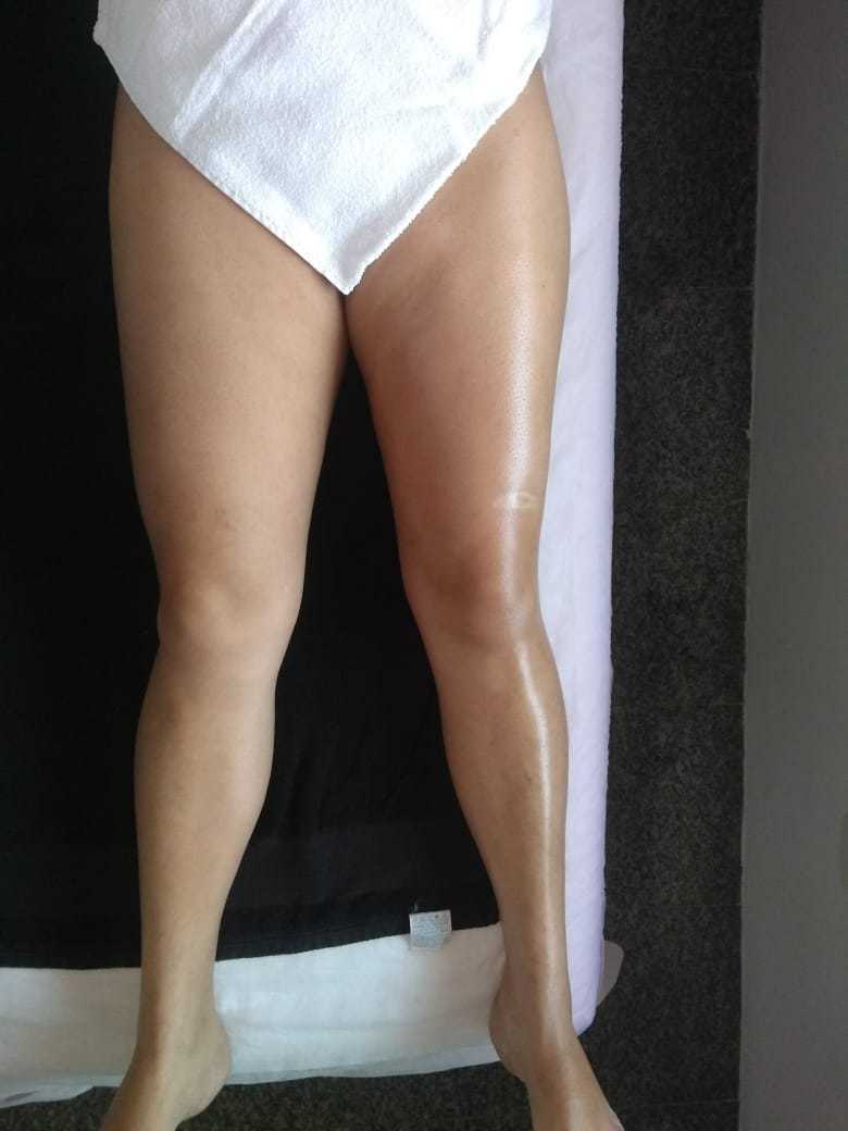 A drenagem bem feita ajuda a eliminar retenção de líquidos e desintoxica o organismo, reparem a diferença de uma perna que foi feita a drenagem e da outra que não foi feita!  estética esteticista depilador(a)