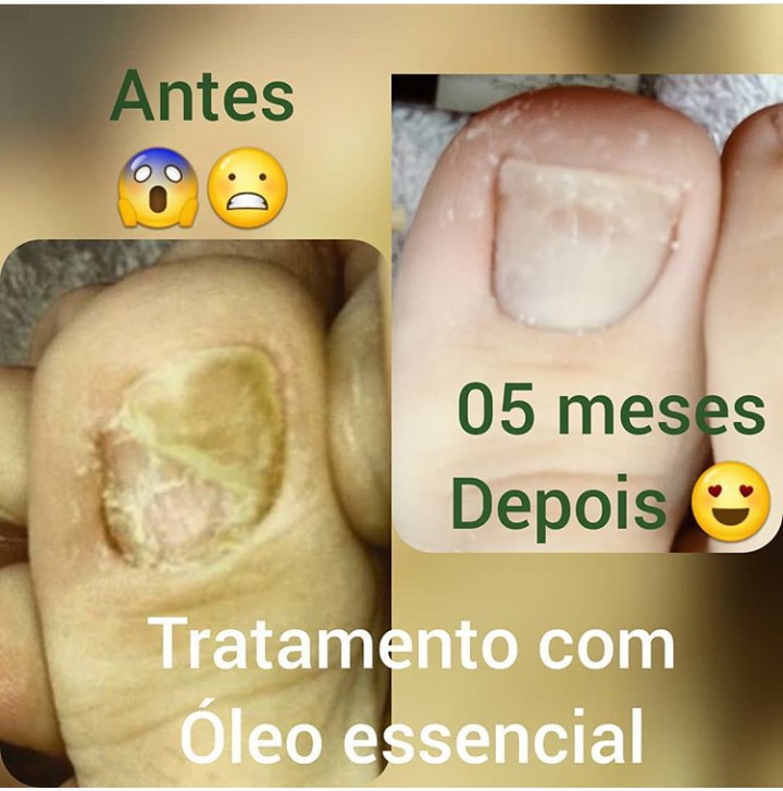 Tratamento de micose 👏👏👏 unha podólogo(a) manicure e pedicure