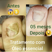 Tratamento de micose 👏👏👏