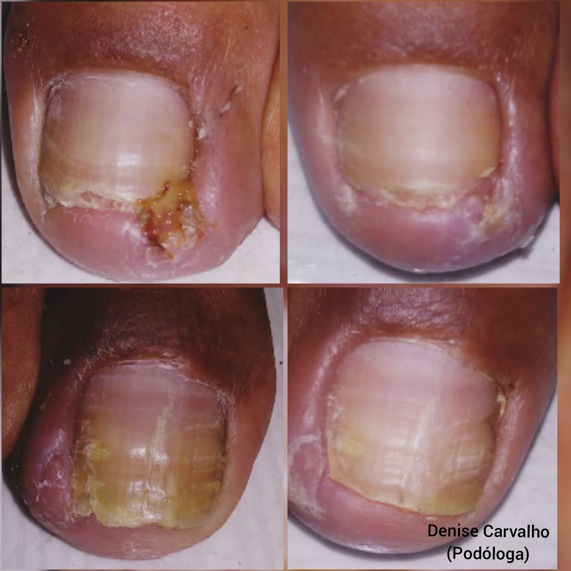 Espículaectomia
Antes e resultado após 02 dias do procedimento.
😍👏 unha podólogo(a) manicure e pedicure