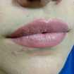 Resultado de micro labial cicatrizada, feita há 10 meses 💋♡