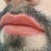 Revitalização labial masculina
(Logo após)