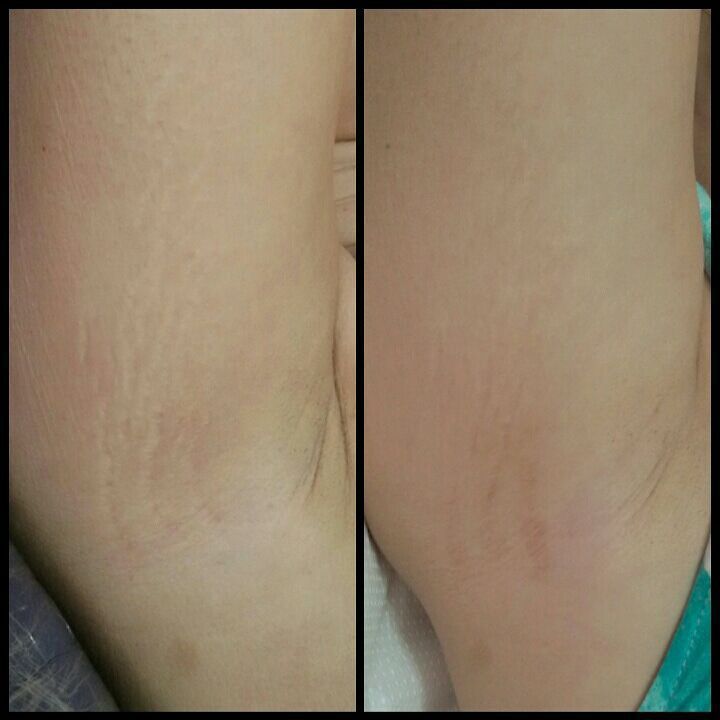 Resultado após 4 sessões de dermopuntura para estrias
ANTES | DEPOIS
-------------------------------------------------
A dermopuntura reduz a profundidade das estrias e devolve a pigmentação por meio de pequenas perfurações na pele, que estimulam a produção de colágeno.
É indicado para estrias brancas, vermelhas/ roxas, largas ou finas, independente da região do corpo. estética dermopigmentador(a) designer de sobrancelhas biomédico(a) maquiador(a) outros