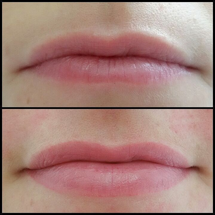 Muitas pessoas acreditam que a micropigmentação labial é indicada para aumentar o tamanho dos lábios. 
Quero esclarecer que o principal objetivo deste tratamento não é este. Para as mulheres que desejam volume, recomendo que procure um especialista e faça um preenchimento com Ácido Hialurônico.

O objetivo da #micropigmetacaolabial é:

Definir o contorno;
Uniformizar a cor labial;
Recuperar o contorno e cor perdidos devido ao processo de envelhecimento;
Melhorar o aspecto de cor escura em ex fumante;
Clarear e Neutralizar lábios naturalmente escuros;
Colorir lábios pálidos; 
Estético, etc.

É surpreendente e natural a mudança! FOTO: ANTES| CICATRIZADO

#micropigmentacao #labioscicatrizados #micropigmentacaolabial #lips #dermografo estética dermopigmentador(a) designer de sobrancelhas biomédico(a) maquiador(a) outros