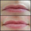 Muitas pessoas acreditam que a micropigmentação labial é indicada para aumentar o tamanho dos lábios. 
Quero esclarecer que o principal objetivo deste tratamento não é este. Para as mulheres que desejam volume, recomendo que procure um especialista e faça um preenchimento com Ácido Hialurônico.

O objetivo da #micropigmetacaolabial é:

Definir o contorno;
Uniformizar a cor labial;
Recuperar o contorno e cor perdidos devido ao processo de envelhecimento;
Melhorar o aspecto de cor escura em ex fumante;
Clarear e Neutralizar lábios naturalmente escuros;
Colorir lábios pálidos; 
Estético, etc.

É surpreendente e natural a mudança! FOTO: ANTES| CICATRIZADO

#micropigmentacao #labioscicatrizados #micropigmentacaolabial #lips #dermografo