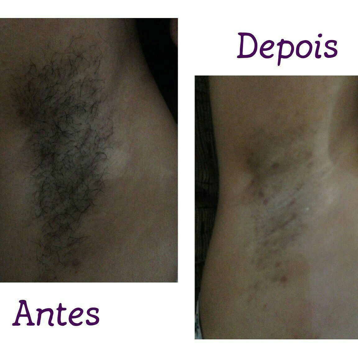 Depilação estética depilador(a) depilador(a) depilador(a) depilador(a) depilador(a) depilador(a) depilador(a) depilador(a)