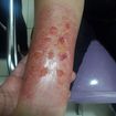Efeito especial para TV e cinema
Queimadura infeccionada
