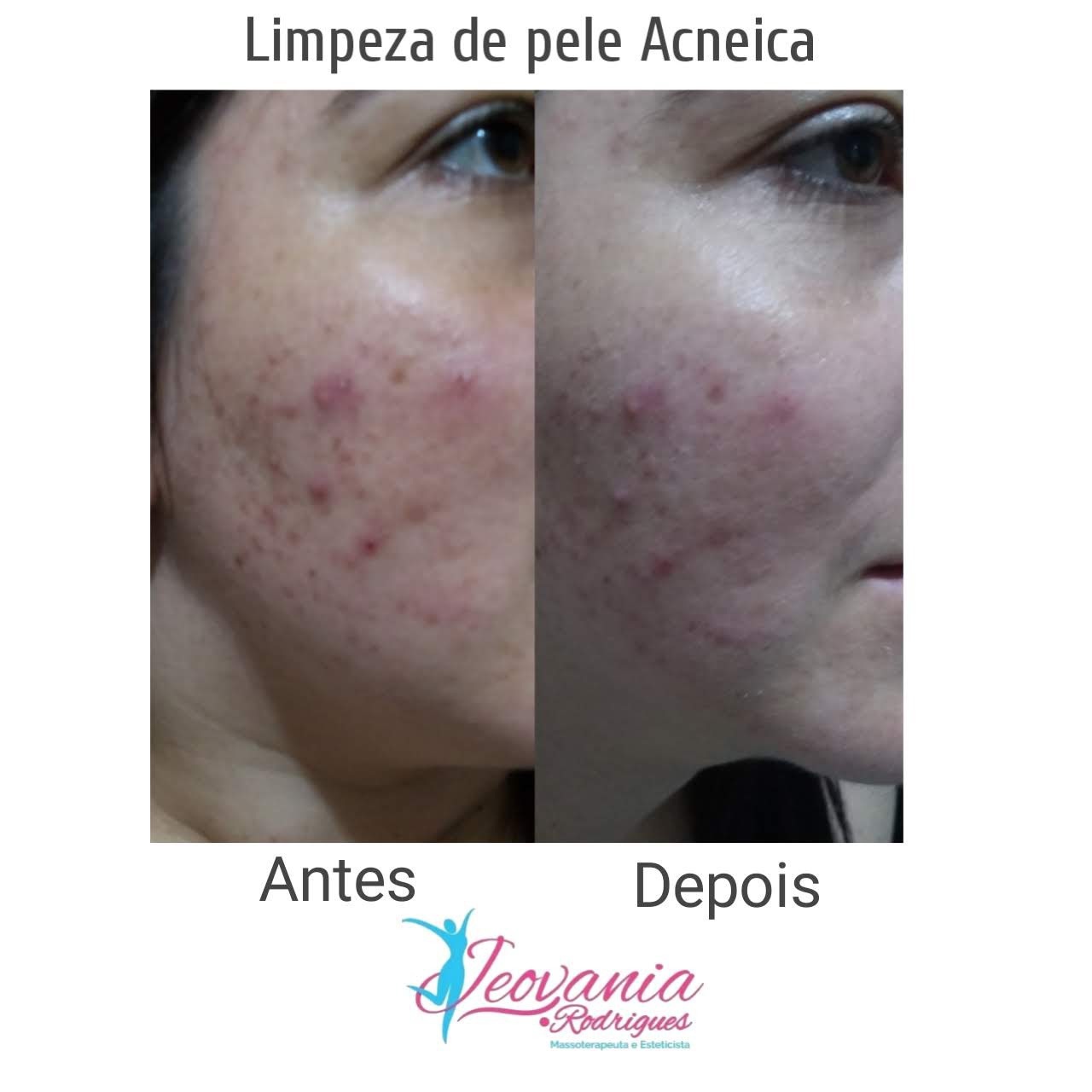 #limpezadepeleracco #peleacneica #resultadomara  estética massoterapeuta esteticista consultor(a)