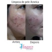 #limpezadepeleracco #peleacneica #resultadomara 