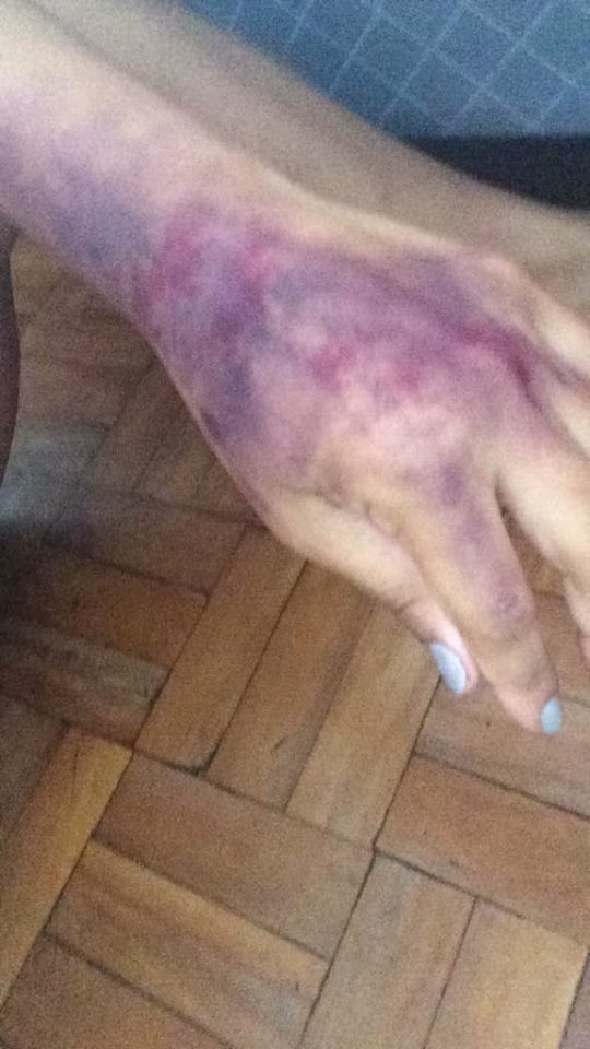 hematoma maquiagem maquiador(a)