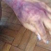 hematoma