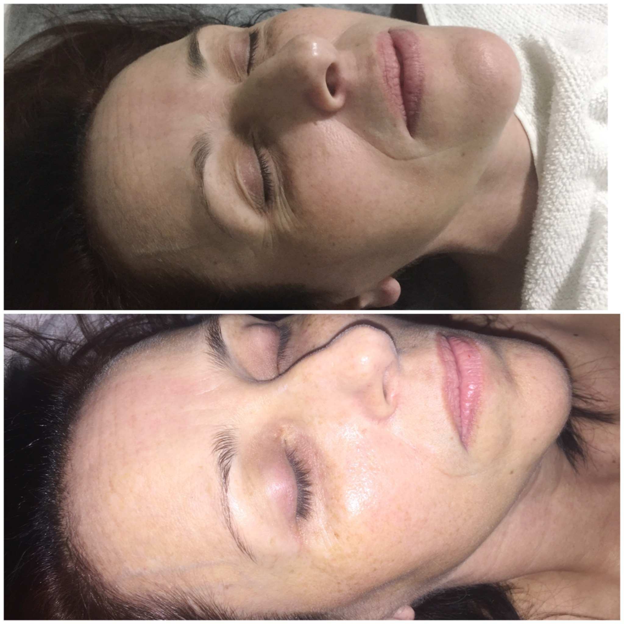 Radiofrequência com revitalização facial. estética esteticista